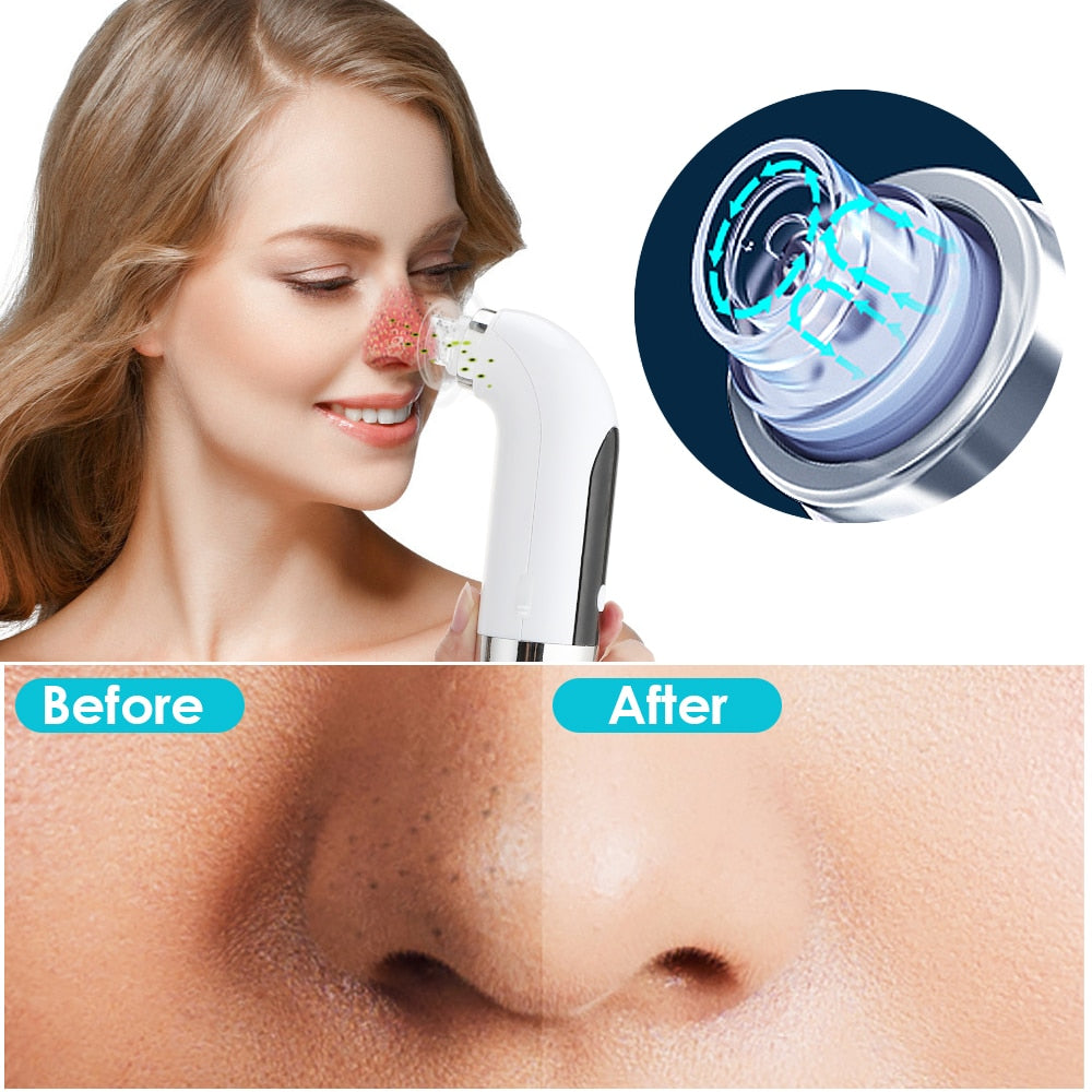 Blackhead Remover Pore Cleaner Vacuum Suction - Hollasoftshop